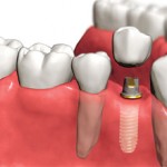 Сколько стоит вставить зубной имплант