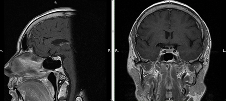 Снимок МРТ мозга