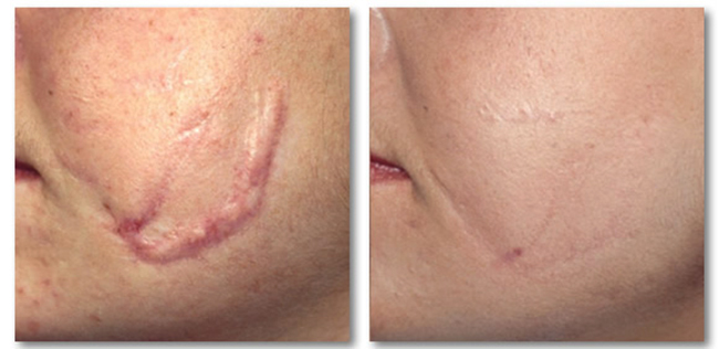 До и после лазерного удаления шрама
