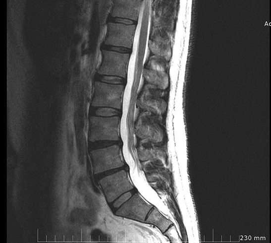 МРТ снимок спины