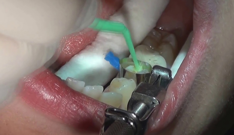 Как делают пломбу на зуб