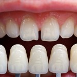 Сколько стоит сделать виниры на все зубы?