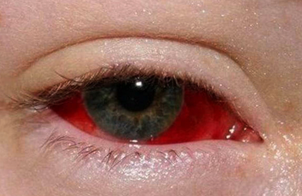 Красный глаз