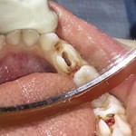 Сколько стоит вылечить пульпит зуба?