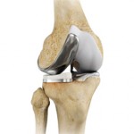 Сколько стоит эндопротезирование коленного сустава?