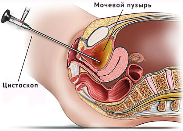 Цистоскопия мочевого пузыря