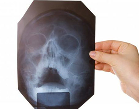 Сколько стоит рентген носа и носовых пазух?