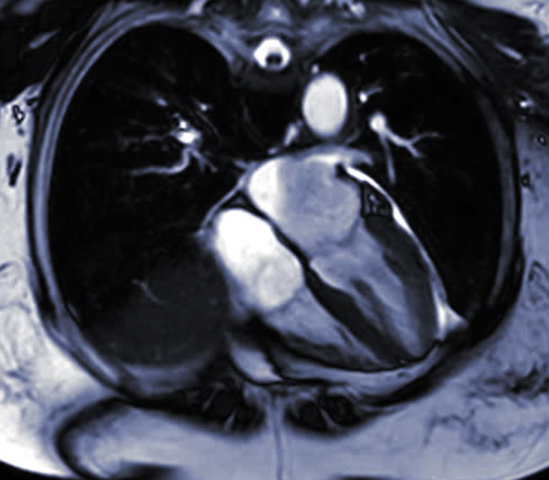 Снимок МРТ сердца