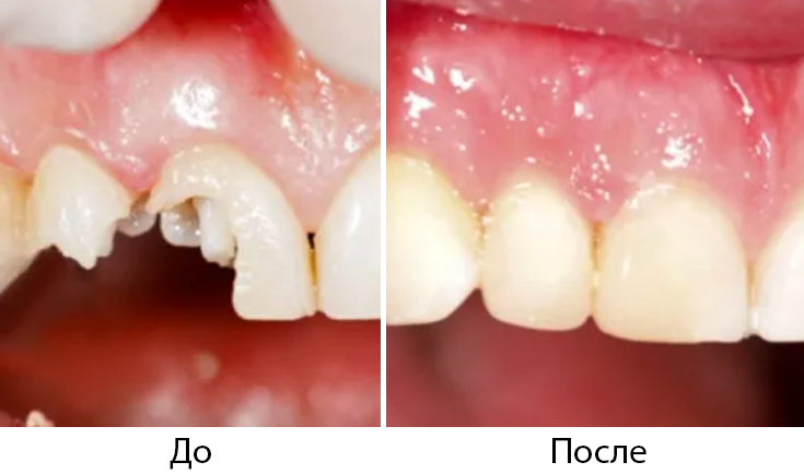 До и после реставрации зубов