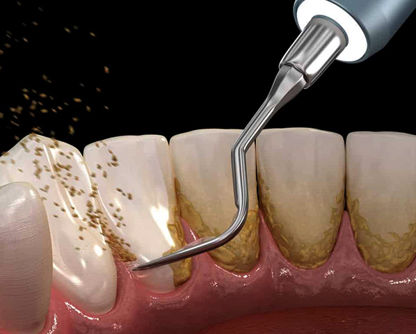 Удаление зубного камня ультразвуковым методом
