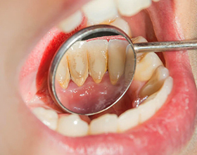 Во сколько обойдется удаление зубного камня: цены и особенности