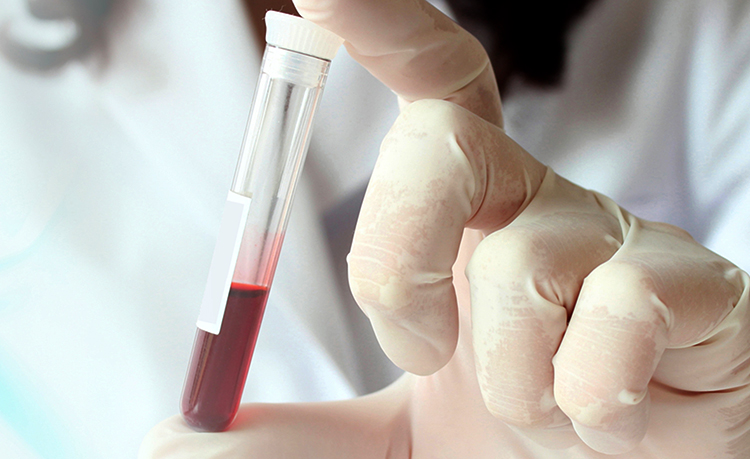 Пробирка с кровью у врача для анализа на пролактин