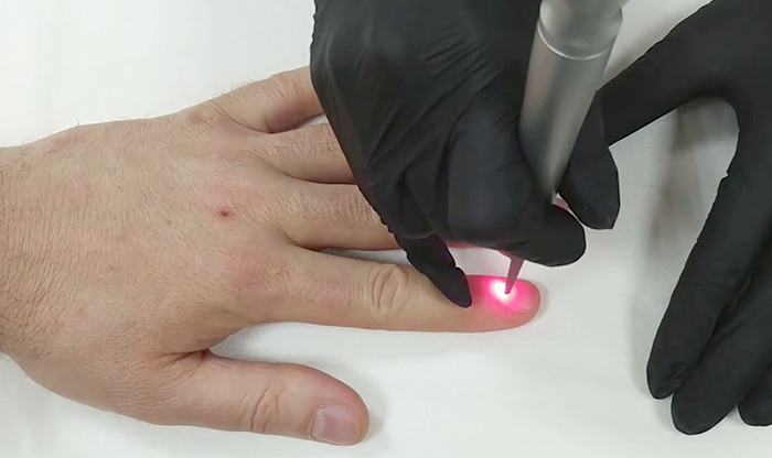 Лечение грибка ногтей лазером на руке