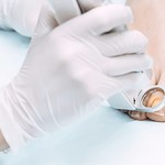 Сколько стоит лечение грибка ногтей лазером?