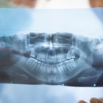 Сколько стоит панорамный снимок зубов (ОТПГ)?